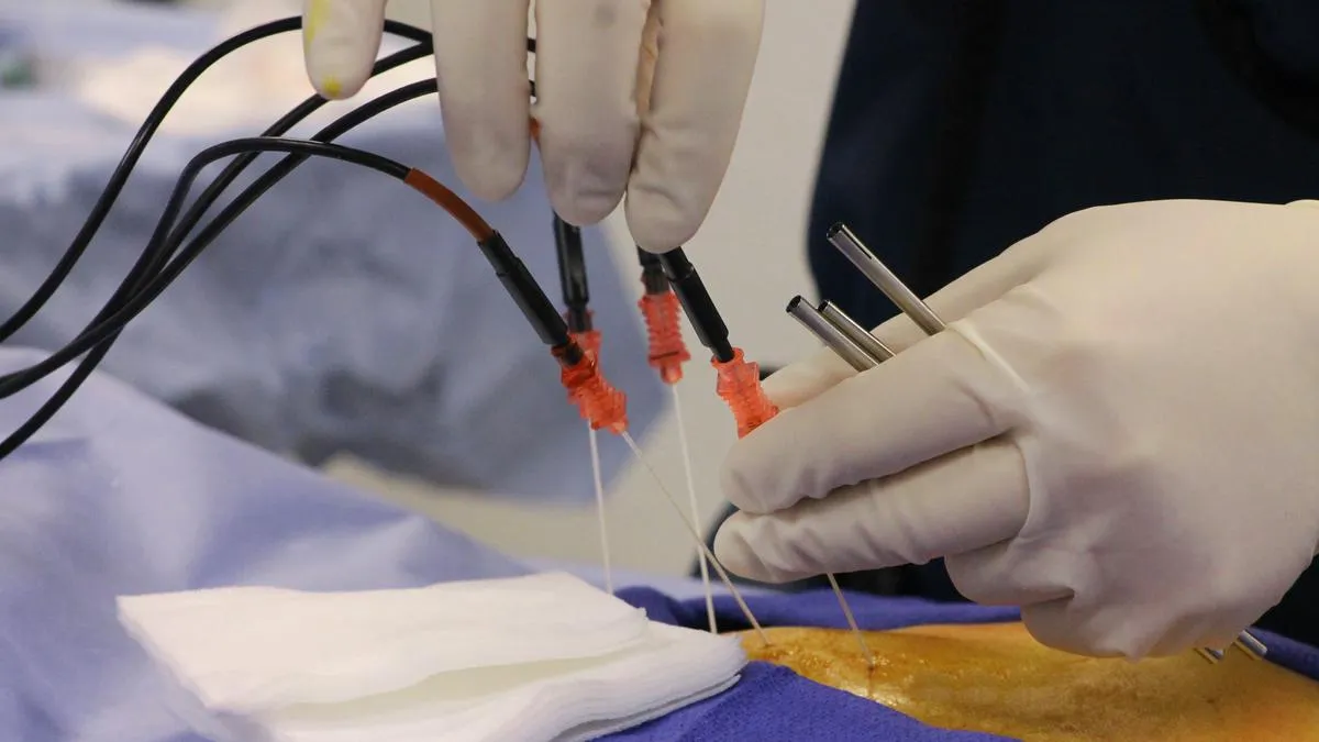 Beyond pills and surgery: how radiofrequency ablation is helping chronic pain sufferers 